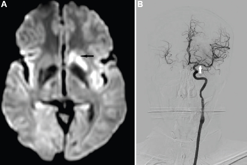 (A) Diffusion weighted imaging done within 24 h post thrombectomy showing residual left basal ganglia restriction (black arrow). (B) Angiogram-recanalized left middle cerebral artery post-thrombectomy (white arrow).